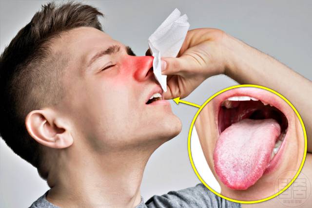 혀백태 원인 제거 혀 백태 안없어짐 비염