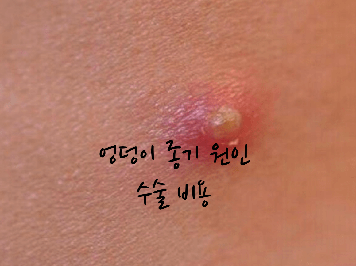 엉덩이 종기