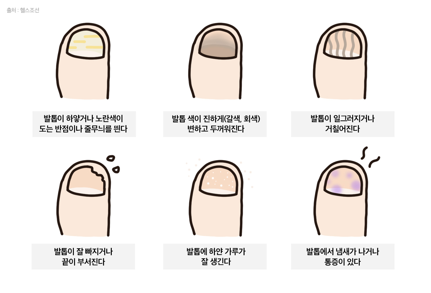 발톱 무좀 관련 사진