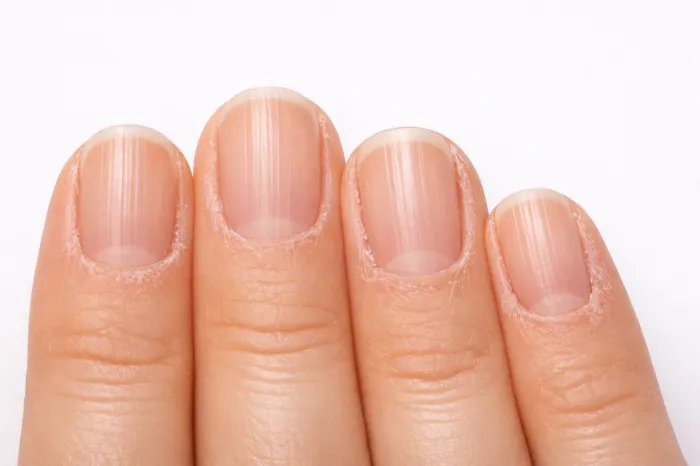 손톱에 세로줄이 생기는 이유
