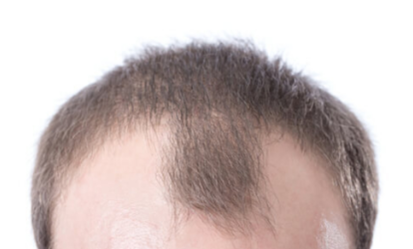 앞머리-탈모-확인