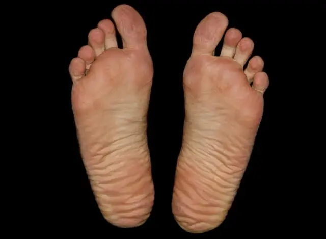 무좀 치료