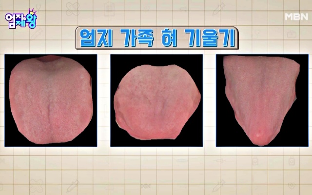 혀로 보는 뇌졸중 초기증상, 혀 기울기, 혀 건강체크, 혀 건강상태, 건강 팁줌 매일꿀정보