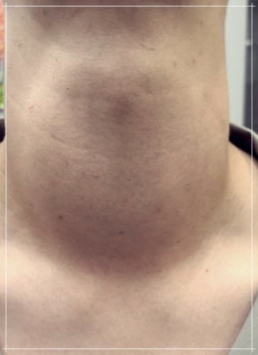 아급성 갑상선염: 증상과 치료법에 대해 상세히 알아보기