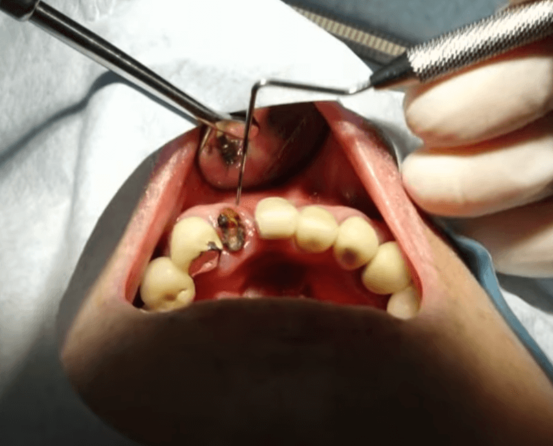 임플란트 주위염 ; 증상, 원인, 예방 및 관리방법 알아보기(재수술, 부작용, 재식립)