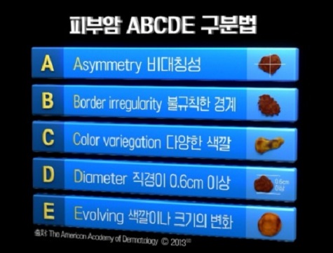 피부암-구분법