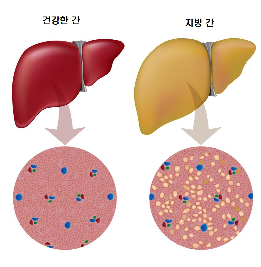건강한 간과 지방간