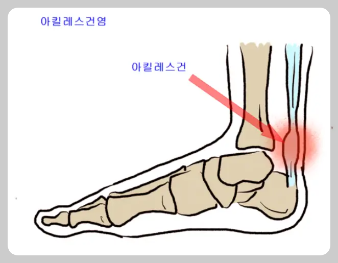 아킬레스건염