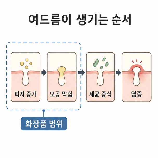 여드름이 생기는 순서, 피지 증가에서 모공 막힘, 세균 증식, 염증까지 이어지는 모공 단면 도해