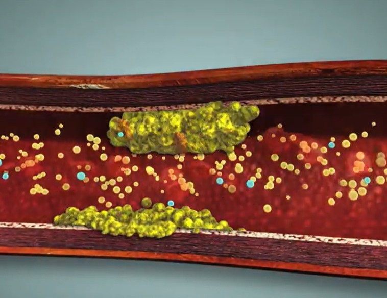 중성지방 정상수치