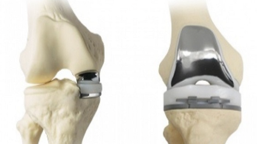 무릎인공관절 수술
