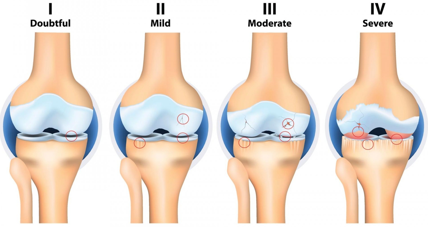 퇴행성 관절염 증상