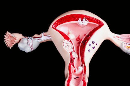 자궁근종 증상 7가지, 수술후 회복기간