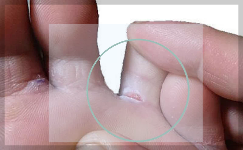 발가락 사이 갈라짐