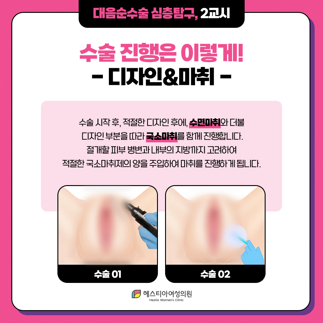 대음순성형수술 
수술 진행사항 
디자인&마취