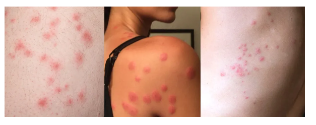 빈대에 물린 모습