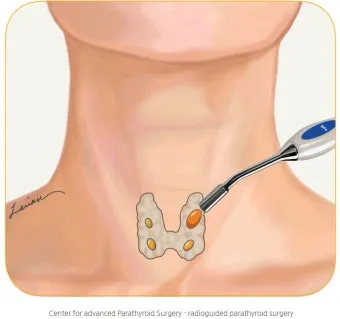 부갑상선기능항진증 수술 후기 2주차 내분비외과 내원 경험담_4
