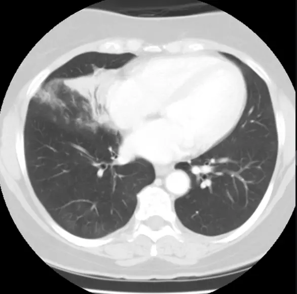 mucinous BAC : consolidation with airbronchogram 