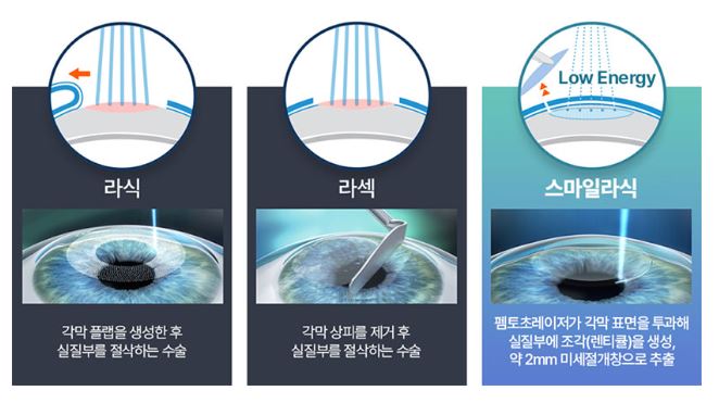 스마일-라식-부작용