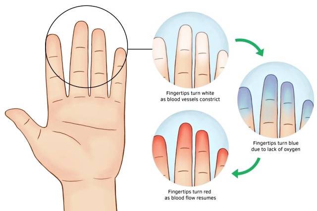 손발이 찬 이유,손발이 찬 체질,수족냉증,레이노증후군