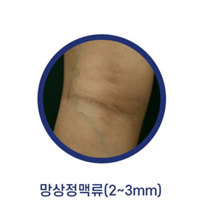 하지정맥류-다리가-붓는-이유
