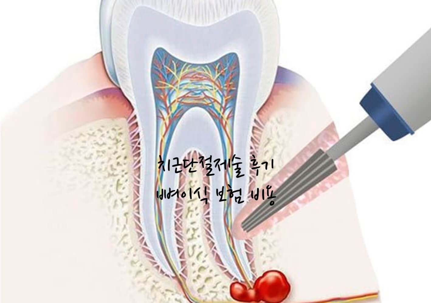 치근단절제술