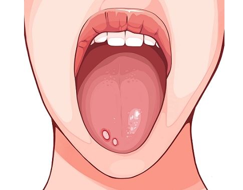 설암(혀암) 초기증상과 원인