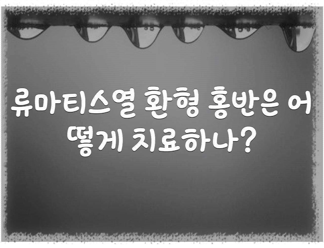 류마티스열 환형 홍반: 류마티스열의 피부 표현 - 알아보자 :: 류마티스열 환형 홍반: 류마티스열의 피부 표현 - 류마티스열 환형 홍반은 어떻게 치료하나? 류마티스열 환형 홍반: 류마티스열의 피부 표현 - 알아보자 :: 류마티스열 환형 홍반: 류마티스열의 피부 표현 - 류마티스열 환형 홍반은 어떻게 치료하나?