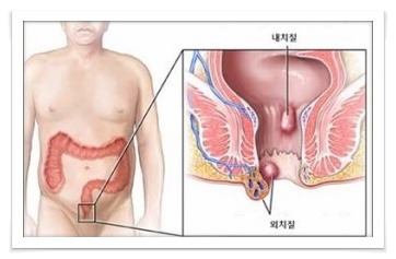 치핵 증상