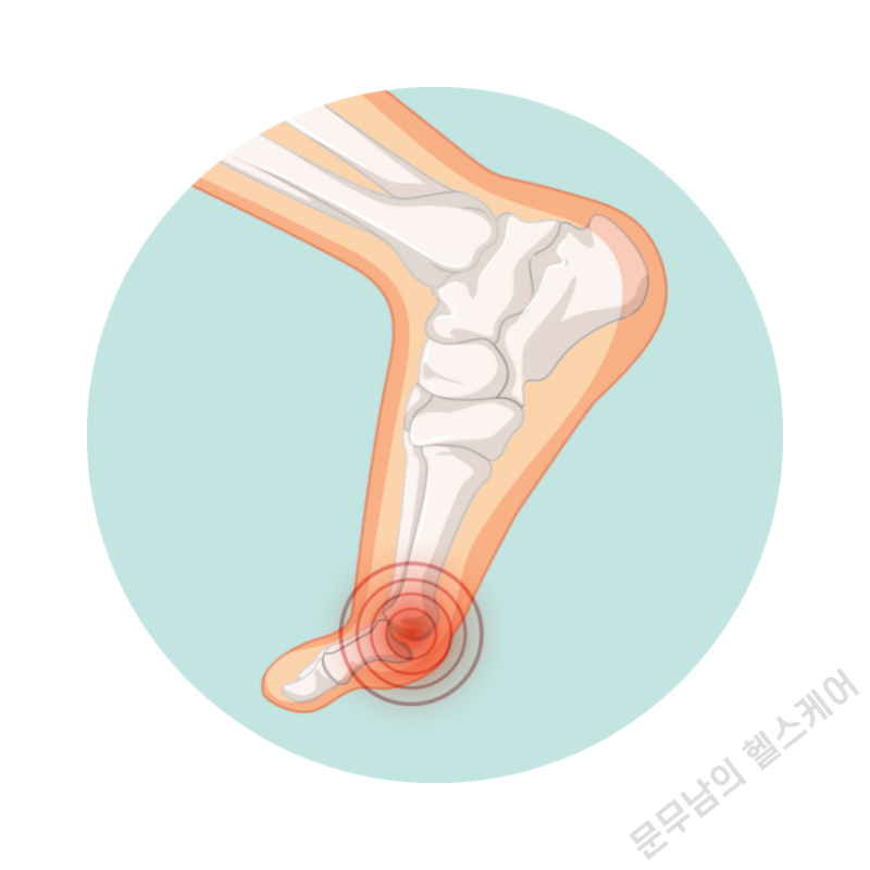 엄지발가락 옆 통증