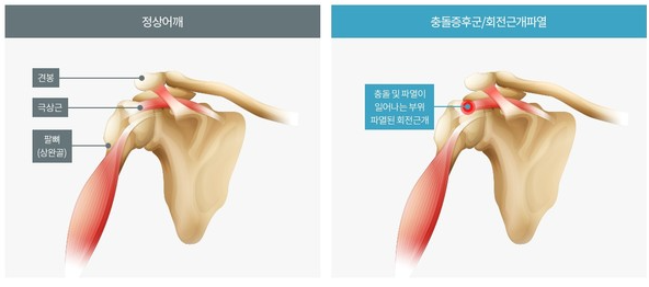 어깨충돌증후군 관련 이미지