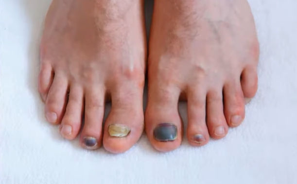 발톱이 검게 변하는 이유