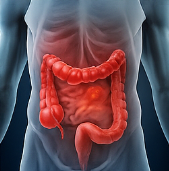 대장암 초기증상