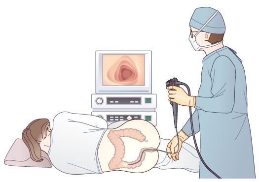 대장암 예방은 대장내시경 검사를 받는 것이다.