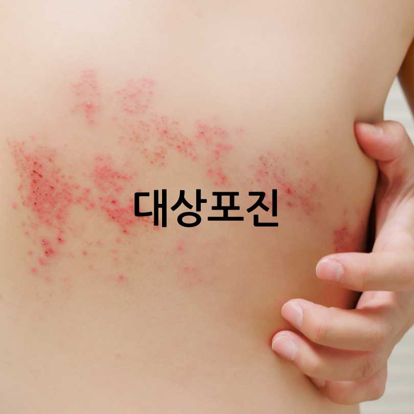  대상포진 예방접종의 모든 것