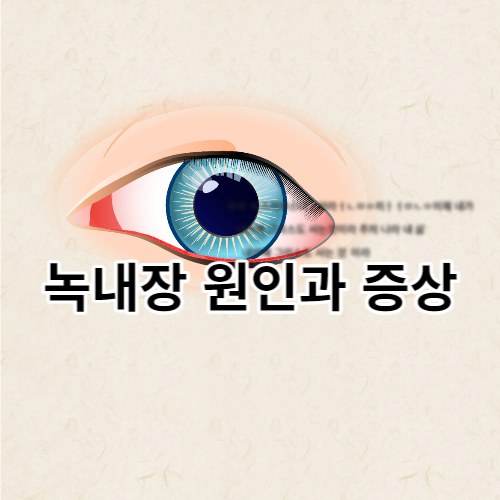 녹내장의 원인과 증상에 대한 글의 썸네일입니다.