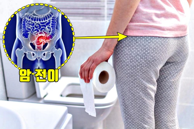 혈뇨 피섞인소변 자궁암 증상 원인, 자궁경부암, 자궁경부암초기증상, 건강 팁줌 매일꿀정보