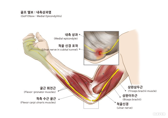 골프엘보