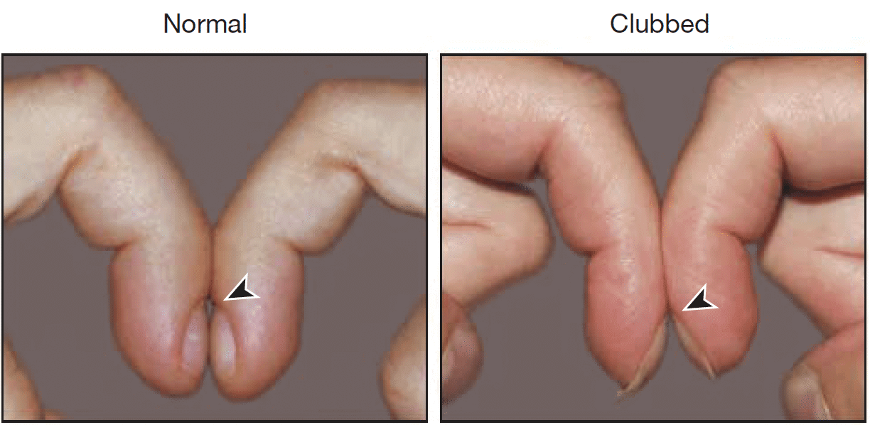 좌측 : 정상 / 우측 : 곤봉지