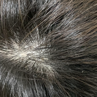 탈모원인과 예방법