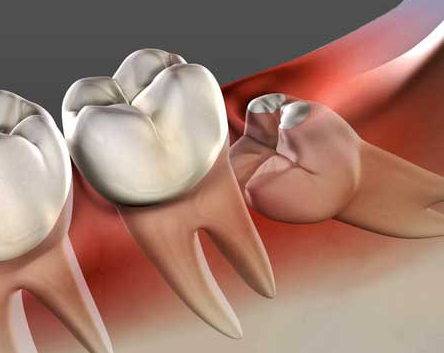 사랑니 발치비용