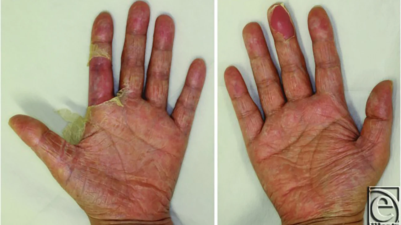 연쇄상구균 독성 쇼크 증후군의 기원과 일본에 미치는 영향