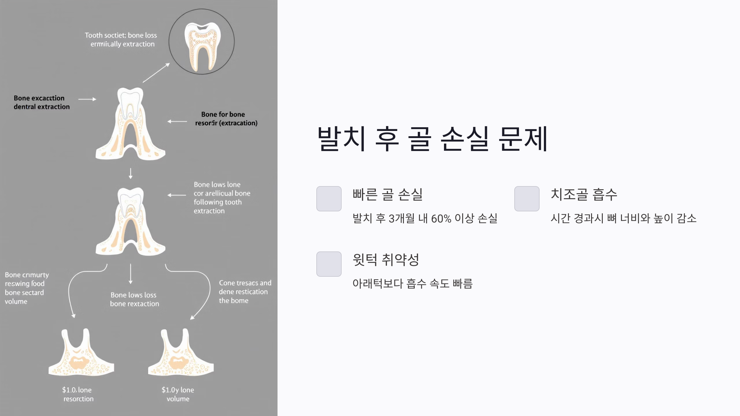 치아 발치 후 인공뼈이식, 시기를 놓치면 어떤 문제가 생길까?