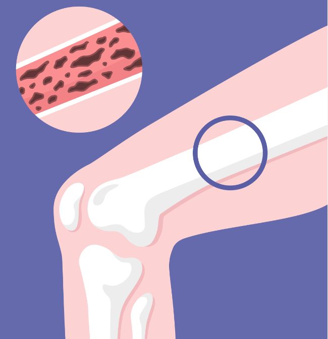 골다공증 주사 부작용