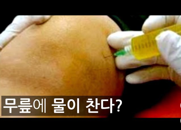 무릎물 치료법