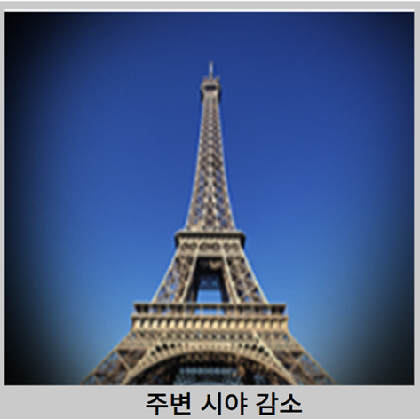 녹내장 증상 - 주변 시야 감소