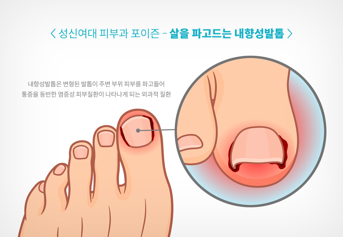 발톱 손질