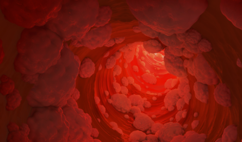 혈관에 콜레스테롤이 낀 사진