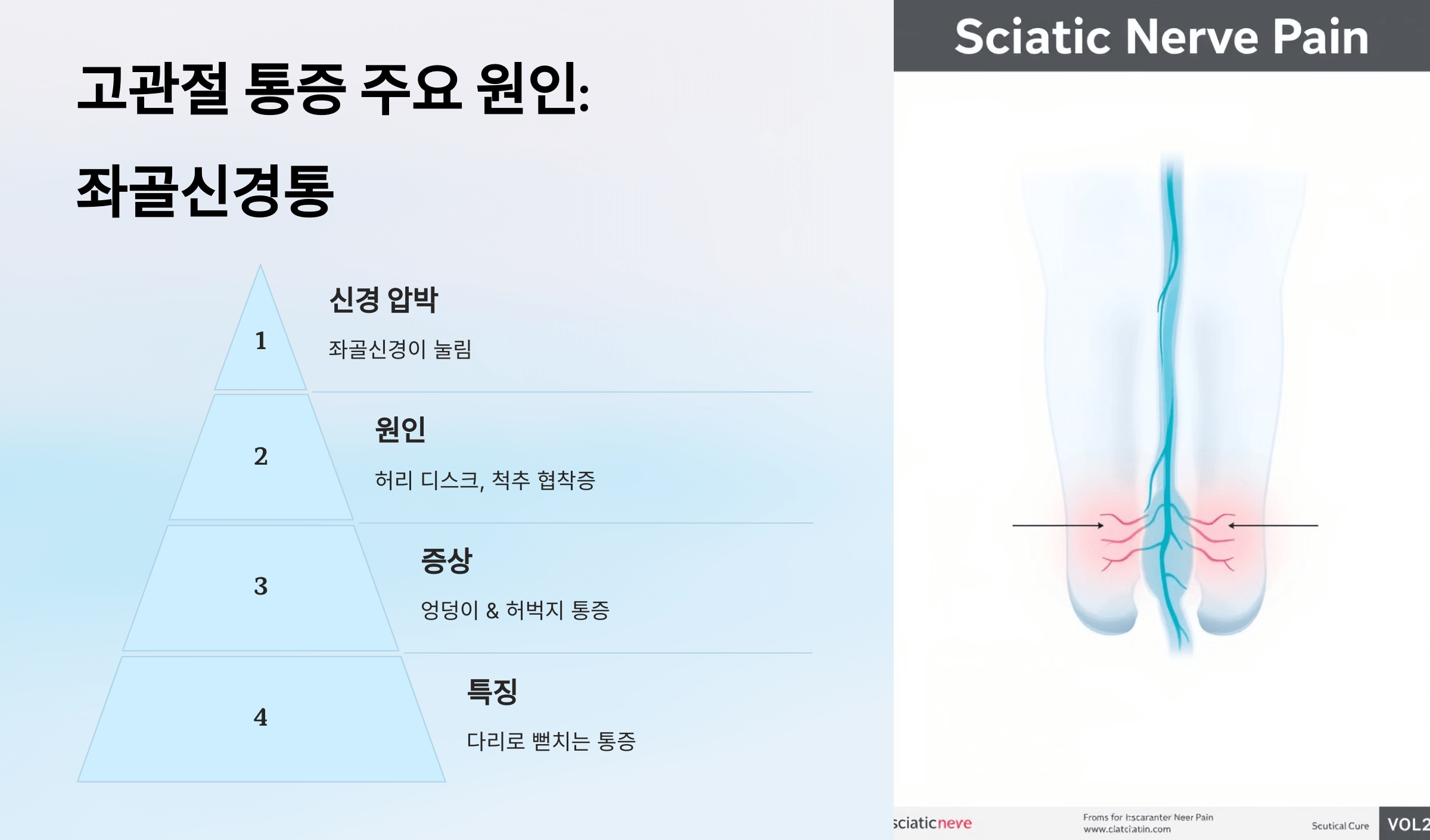 고관절 사진입니다.