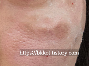 리팟레이저 후기 